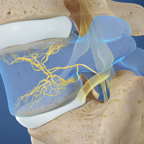 basivertebral_ablation basivertebral_ablation